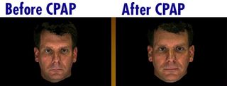 These images were taken before and after a patient underwent treatment for sleep apnea.