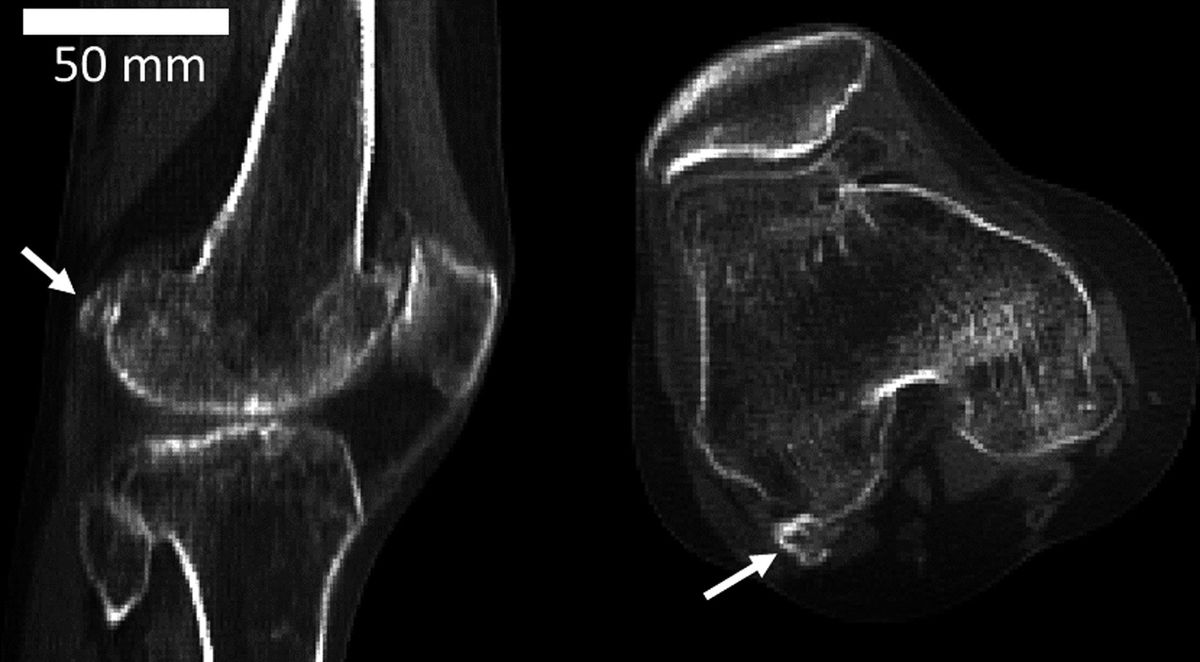 The fabella (white arrows), a tiny bone hidden in the tendon of the knee, is increasing in prevalence in the population.