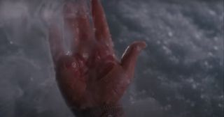 Harry's burned hand.