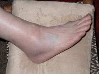 A sprained ankle can get bruised and swollen.