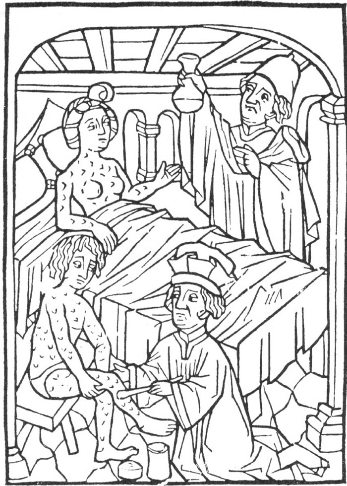 Earliest known medical illustration of syphilis, Vienna, 1498.