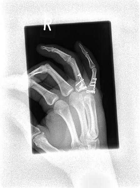 Ouch! An x-ray of Hansen's hand,