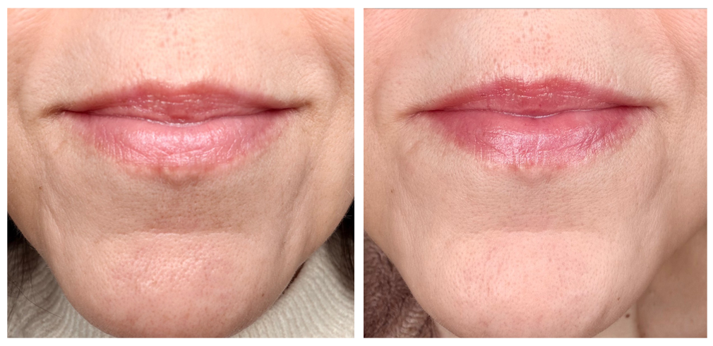 Shiseido Vital Perfection Before &amp;amp; After