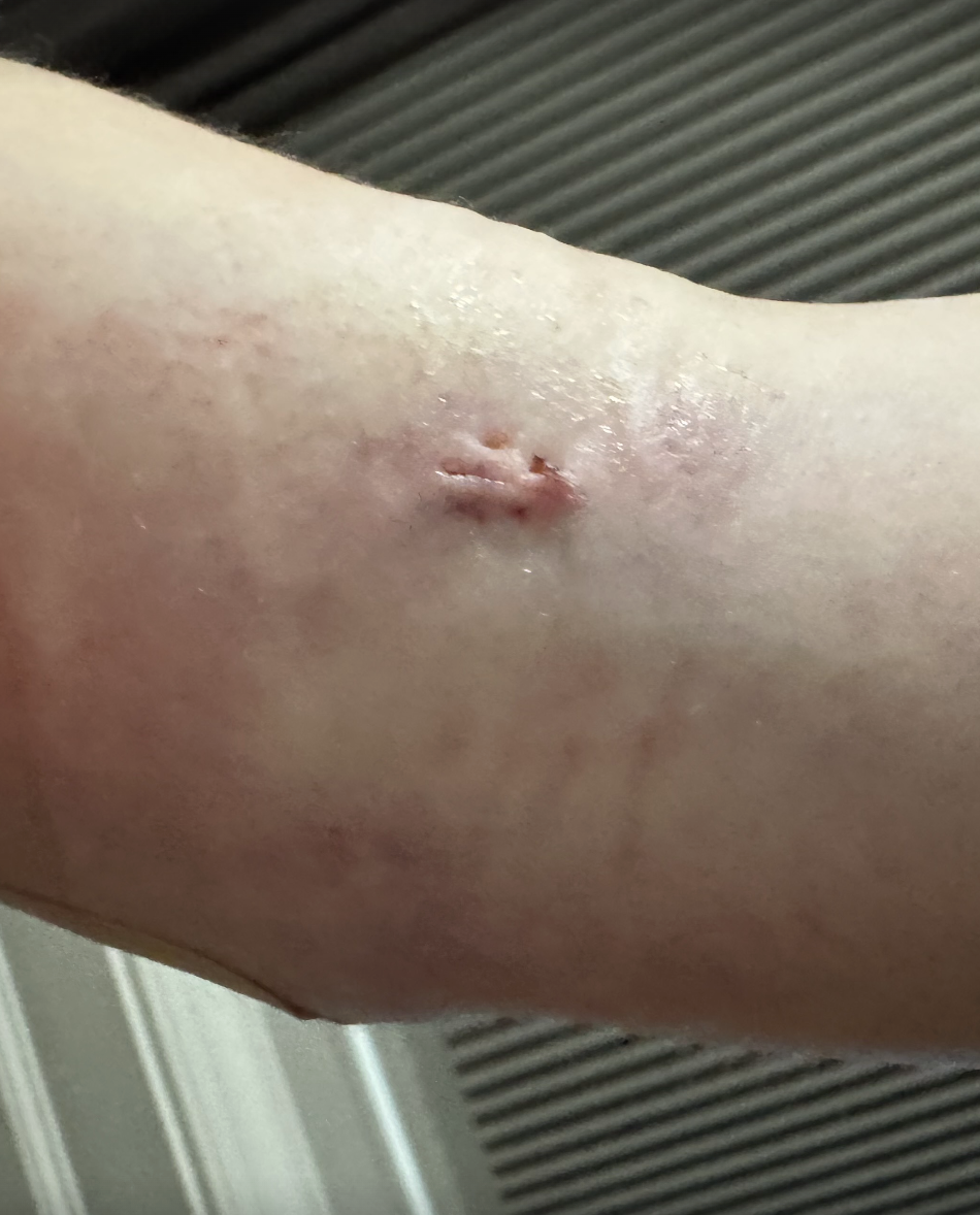 Samantha Holender's incision right after removing the gauze.