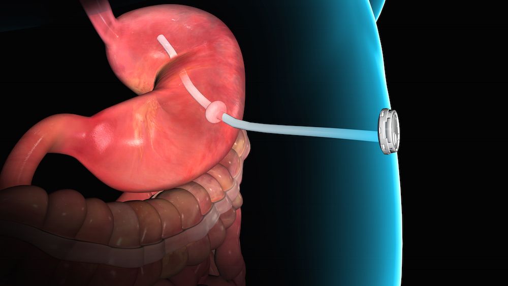 Stomach Sucker: How Does New Weight-Loss Device Work? | Live Science