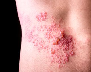 Shingles causes unpleasant blisters typically on only one side of the body.