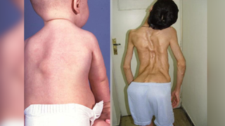 Composite image showing a baby's back on the left-hand side and a child on the right-hand side, both with FOP. The background is an enlarged version of the image that is blurred.