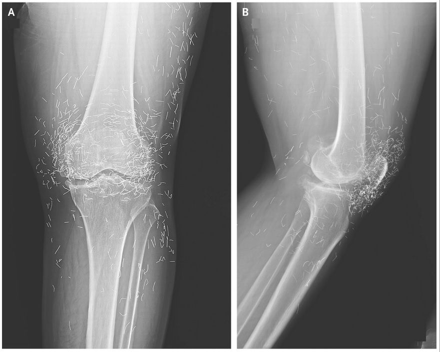Diagnostic dilemma: Woman's severe knee pain reveals 'golden threads' in her joints