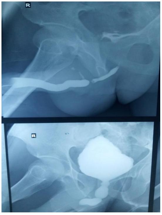 Medical images showing two views of a man's pelvis, with his bladder and urethra shown in light blue and white