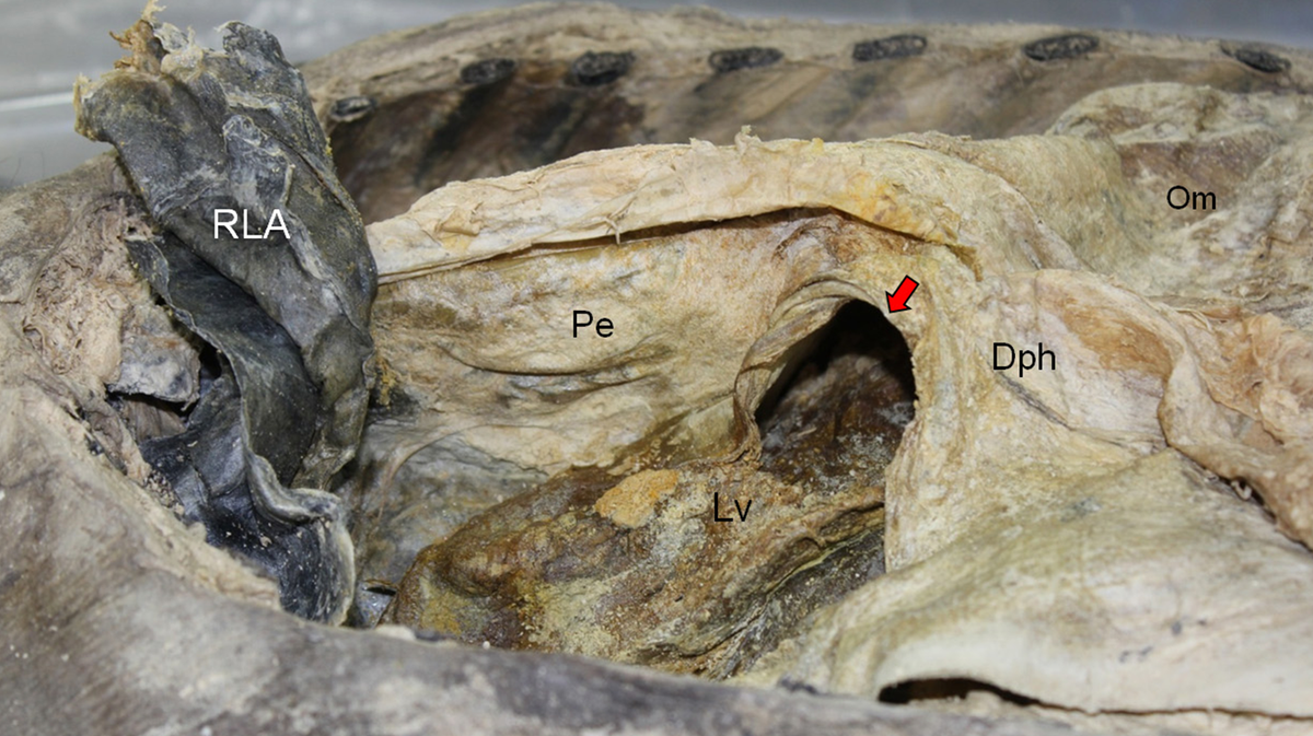 A photo of the mummy&#039;s hernia