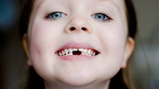 Are teeth considered bones? image shows child smiling with missing tooth