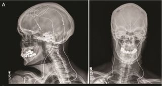 Alzheimer's disease patients received deep brain stimulation as part of a new study. Above, an X-ray image of a deep brain stimulation implant.