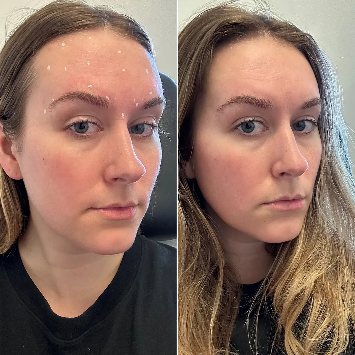 Beauty editor Kaitlyn McLintock getting neurotoxin injections