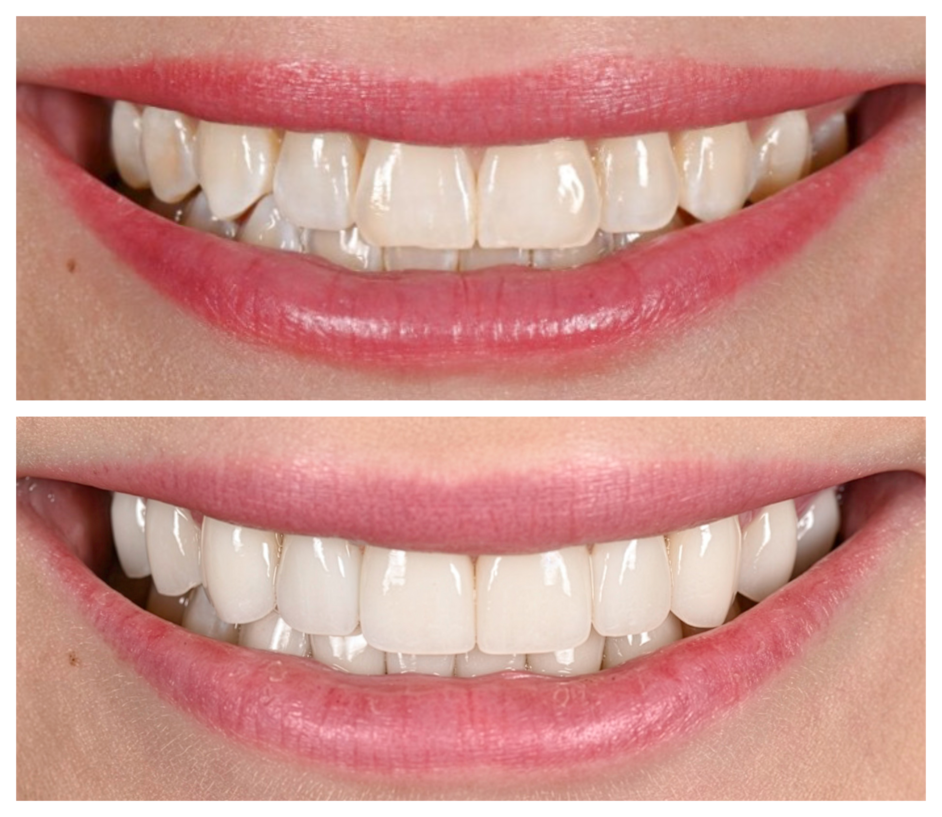 veneers before and after photos on top and bottom, with a woman&#039;s mouth smiling