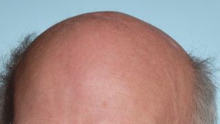 Have we finally found a cure for baldness?