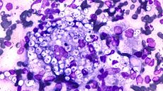<em>Histoplasmas capsulatum</em> usually infects a person's lungs. Here, the fungus is shown in a lung nodule.