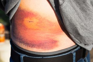 A picture of a person with a huge bruise on their side.