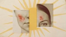 Photo collage of a vintage style illustration of a sun, with two fragments of women's faces in the foreground; they are both marked with eczema-like blotches