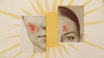 Photo collage of a vintage style illustration of a sun, with two fragments of women's faces in the foreground; they are both marked with eczema-like blotches