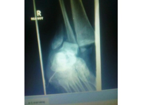 An x-ray of the ankle before the operation