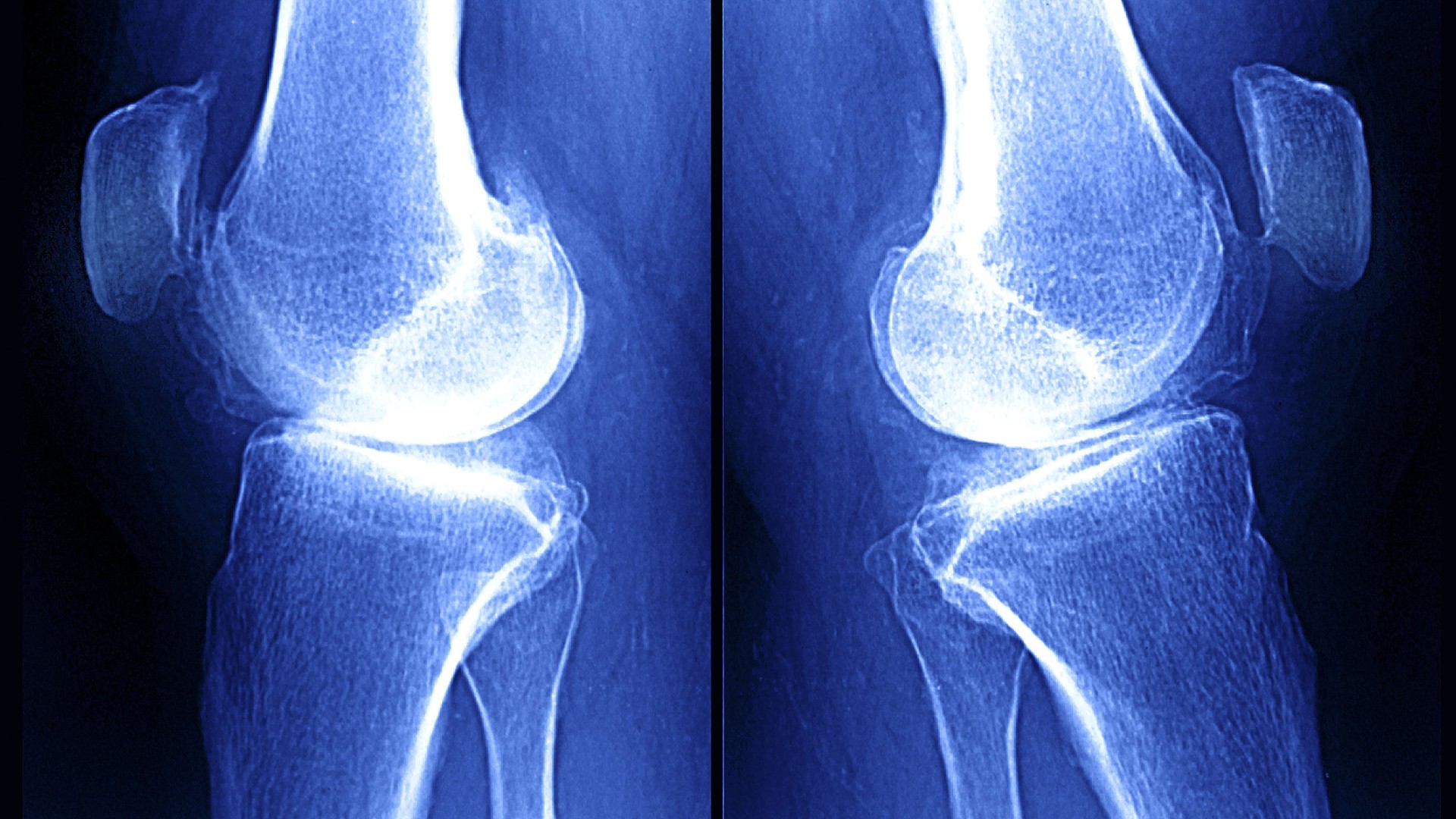 Composite image of two, blue-tinged X-ray images of a knee with osteoarthritis. A black line separates the two images