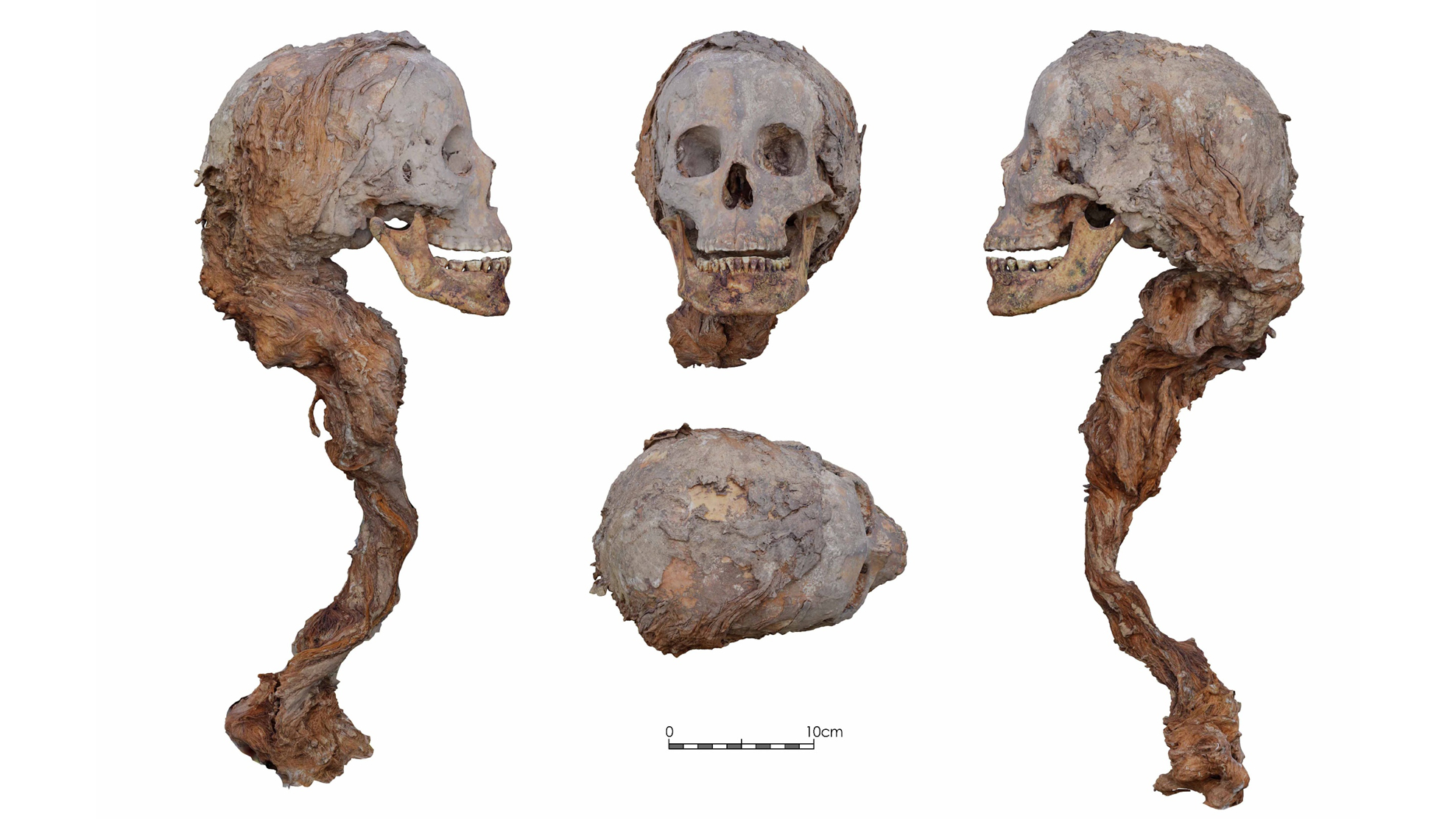 four views of a human skull with a ponytail still attached