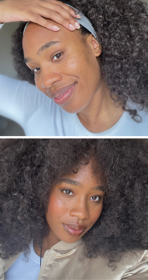 L'Or&amp;eacute;al Blackett before and after DPN removal