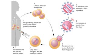 Gene therapy is the insertion of genes into an individual's cells and tissues to treat a disease. This diagram shows an example of ex vivo gene therapy.