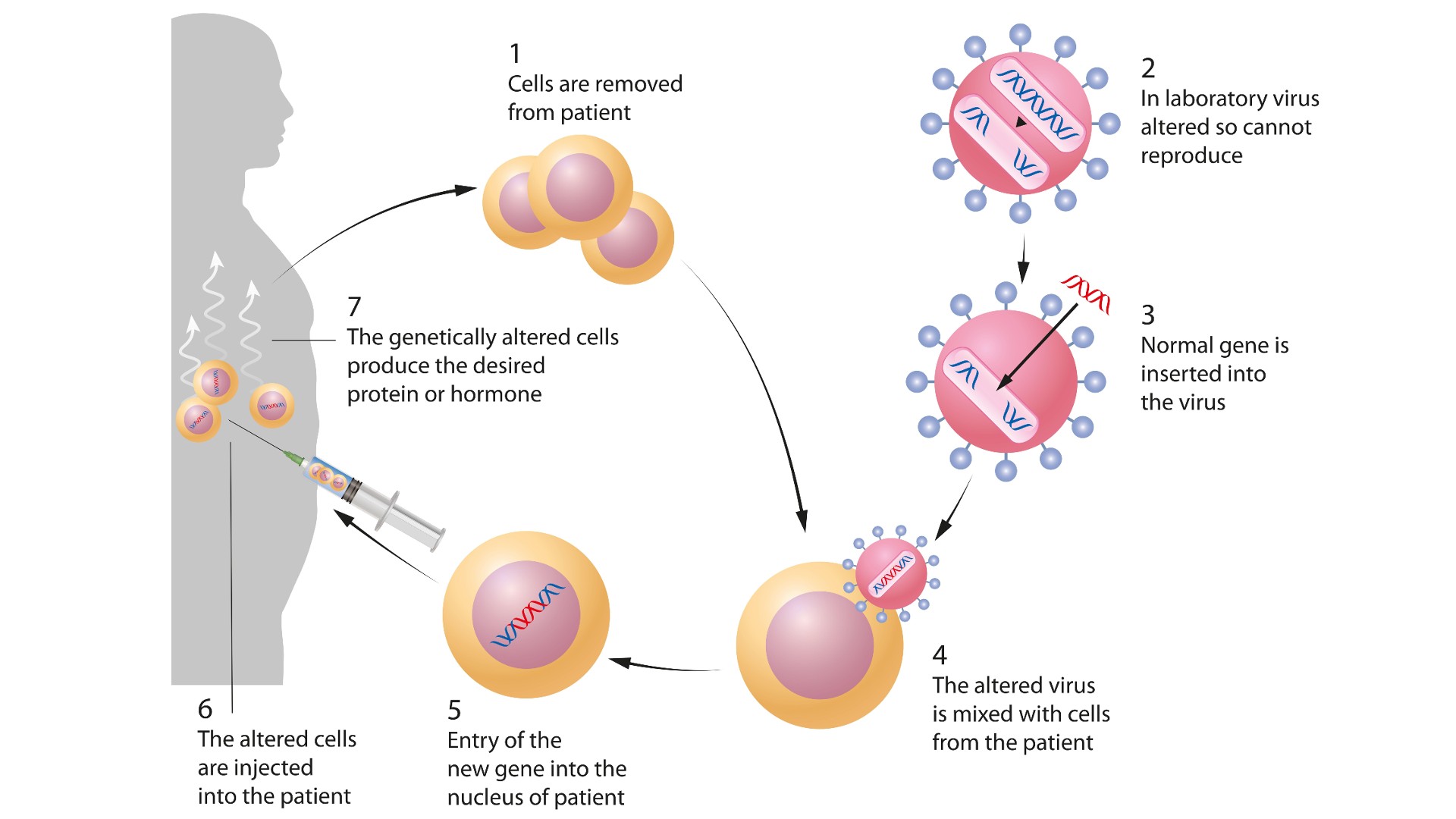 Gene therapy is the insertion of genes into an individual's cells and tissues to treat a disease. This diagram shows an example of ex vivo gene therapy.