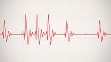 illustration of an irregular heartbeat