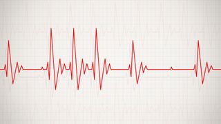 illustration of an irregular heartbeat