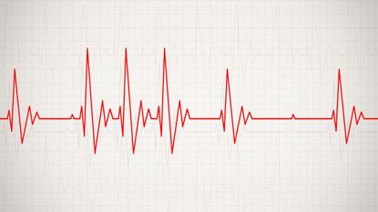 illustration of an irregular heartbeat