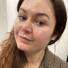 Lucy's skin after the Hydrafacial