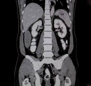 An abdominal CT scan image.