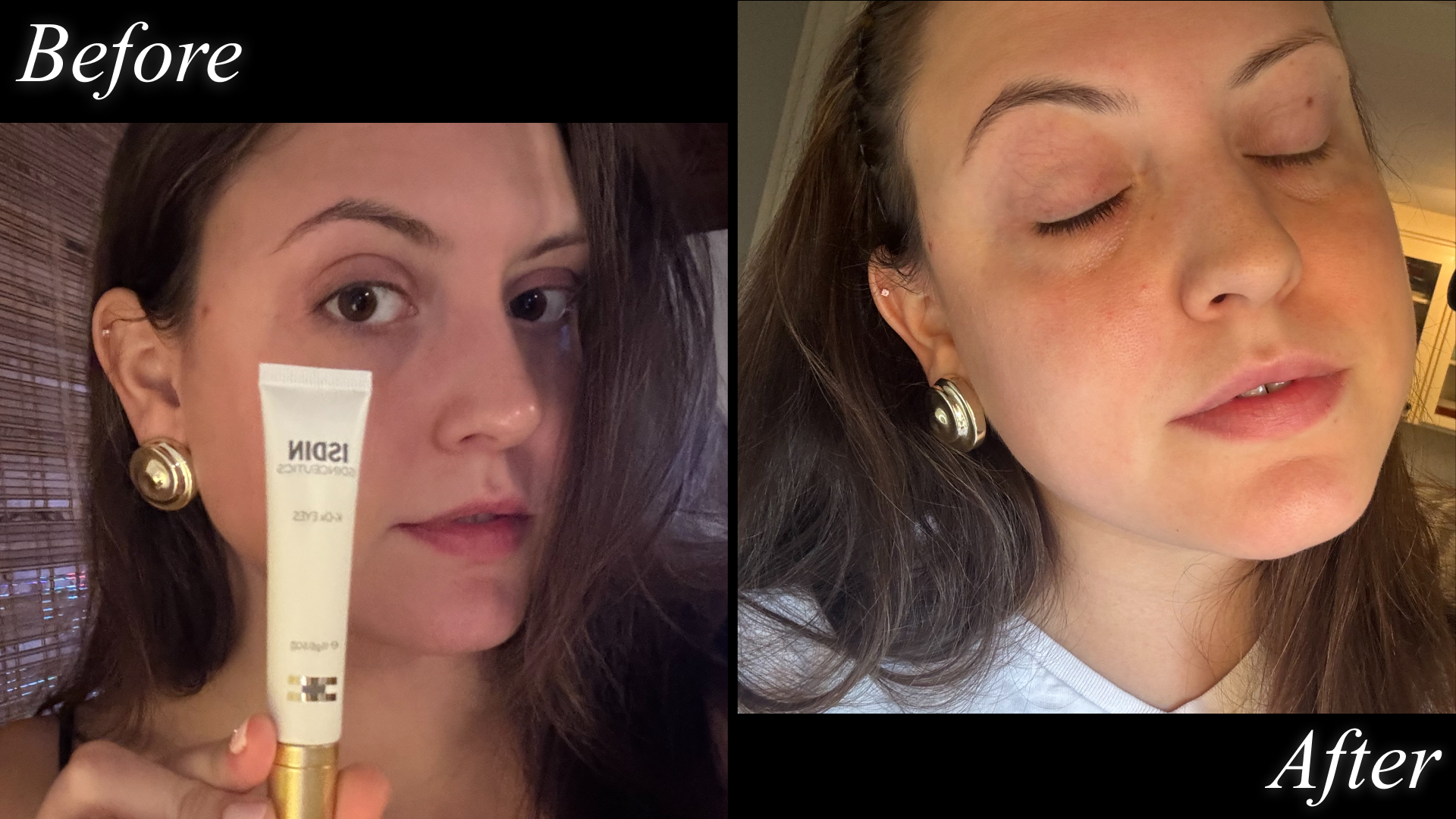 Contributing beauty writer Sophia Vilensky before and after testing Isdin&#039;s K-Ox Eye eye cream.
