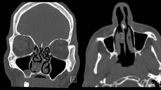 CT scan showing a firm grey mass in the man's right nasal cavity