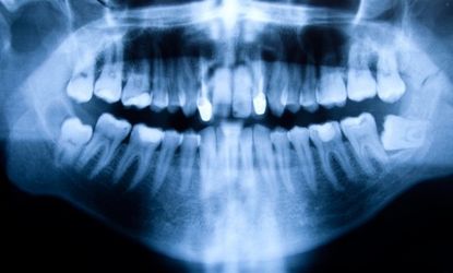 That iron apron the dentist outfits you with during X-rays may not be foolproof, as a new study finds a link between frequent dental X-rays and brain tumors.