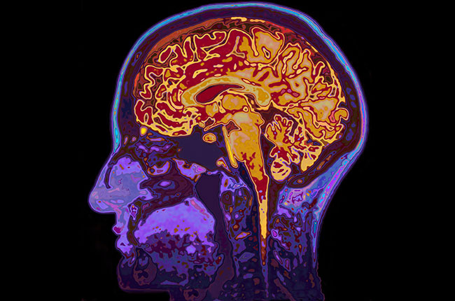 wine dementia, brain scan