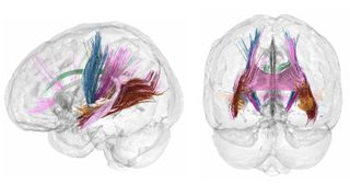 An image showing white matter tracts in the brain