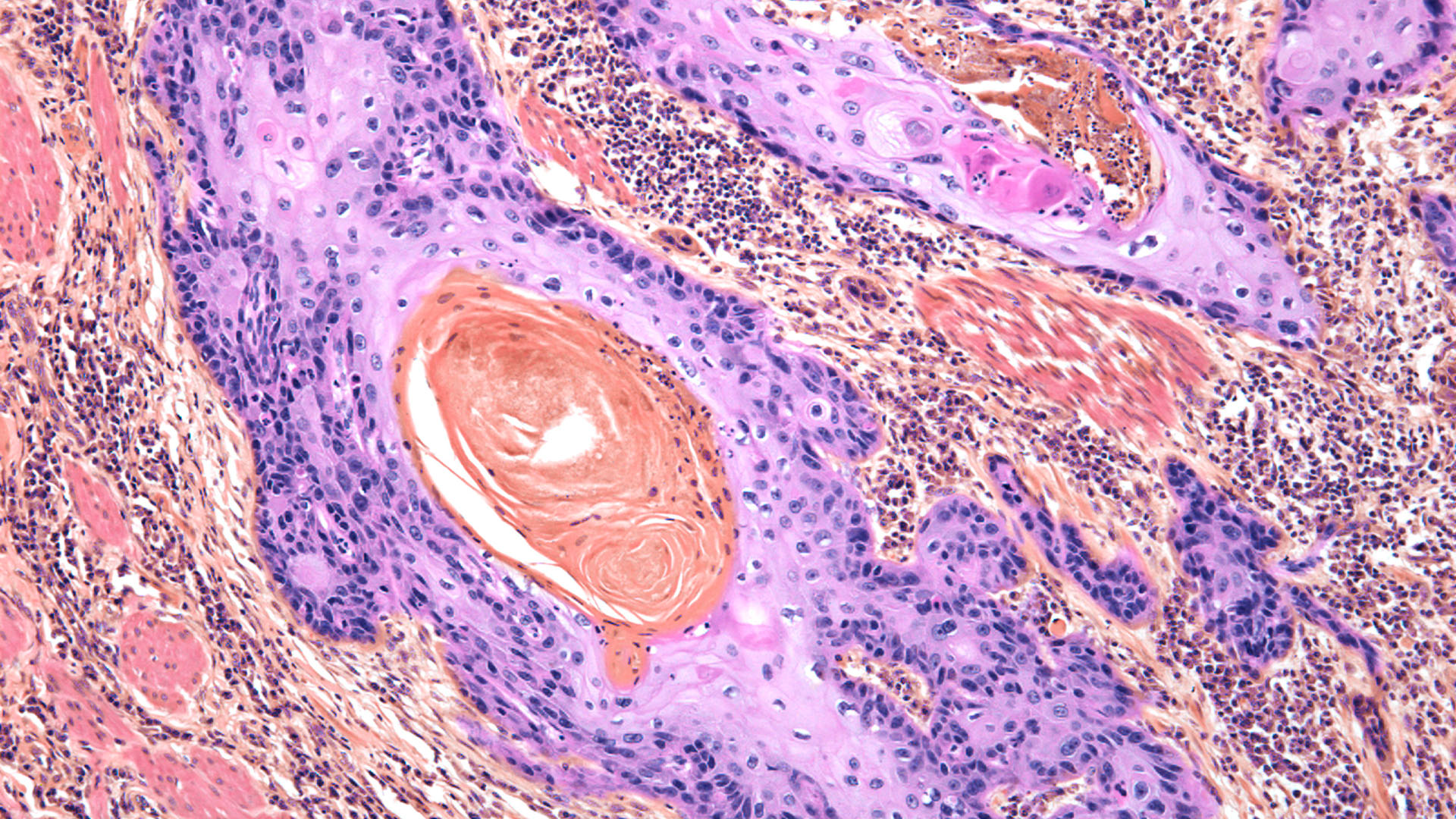 Light micrograph of a section through a squamous carcinoma of the skin.