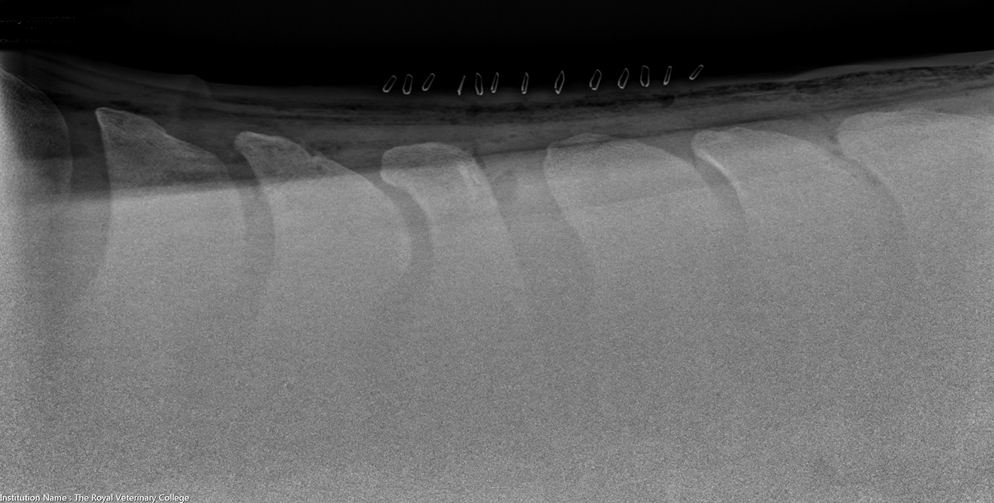 After-kissing-spines-surgery