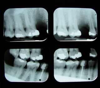 The Relationship Between Black Mold and Tooth Decay