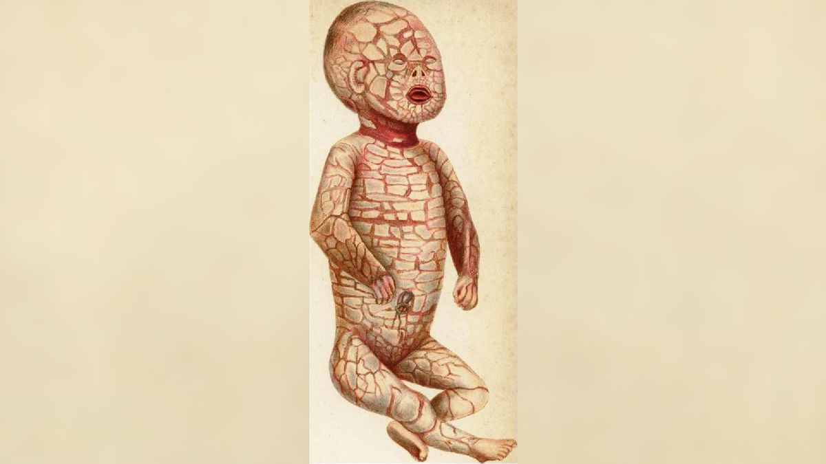 Harlequin ichthyosis: The rare genetic disease that gives babies hard 'scales'