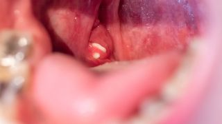A tonsil stone in a patients mouth
