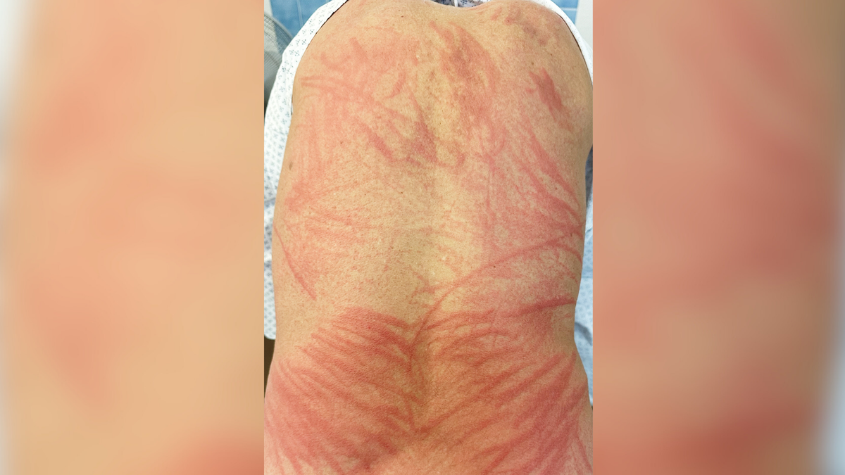 Shiitake Diarrhea At William Bremner Blog