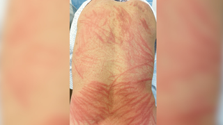Close-up image of the patient's back with red, inflamed crosshatched patches