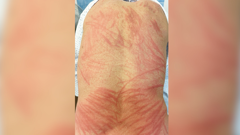 Man gets rare 'shiitake dermatitis' from undercooked mushrooms Live