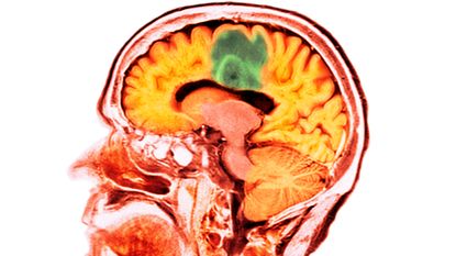 Glioblastoma brain cancer. Coloured computed tomography (CT) scan of a section through the brain (side-view) of an 84-year-old female patient with glioblastoma (dark, top).