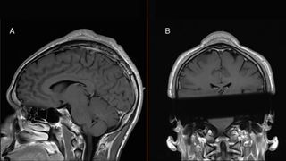 two mri images of a person&#039;s head shown facing the side and then the back. A large lump can be seen on top of the skull from both angles