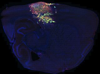 Glioma in a mouse brain